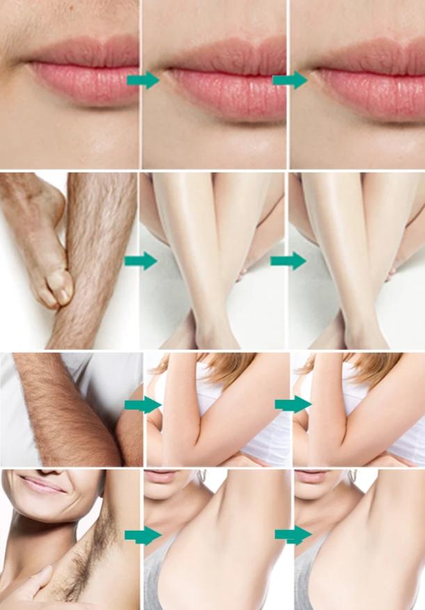 Plaukų-augimą-stabdantis-purškiklis