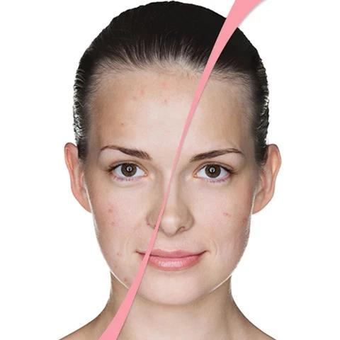 Fotonų-EMS-radijo-dažnio-bangų-ir-elektroporacijos-prietaisas-veidui